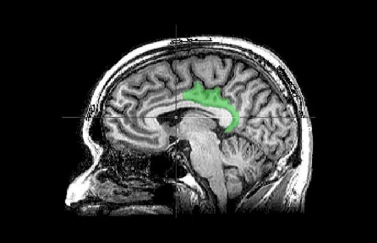 An M.R.I. scan of a brain highlighting the posterior cingulate cortex. In a study, traumatic memories appeared to engage this area, which is usually involved in internally directed thought, like introspection or daydreaming. Geoff B. Hall