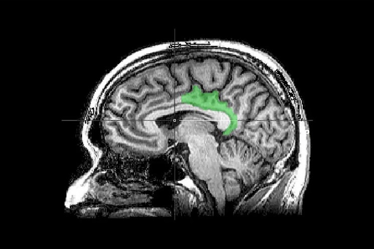An M.R.I. scan of a brain highlighting the posterior cingulate cortex. In a study, traumatic memories appeared to engage this area, which is usually involved in internally directed thought, like introspection or daydreaming. Geoff B. Hall
